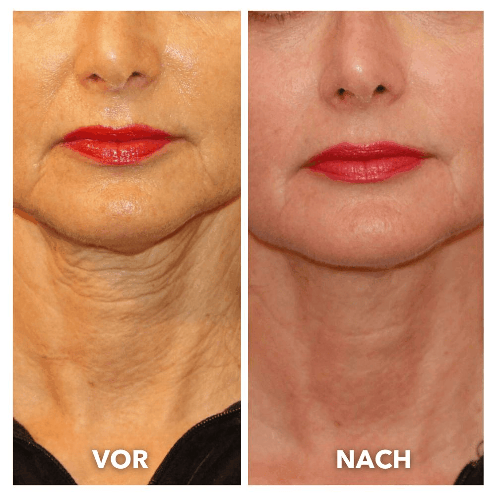 V-Lift Pro – Dein Sculpting-Tool für eine definierte Jawline & straffe Konturen
