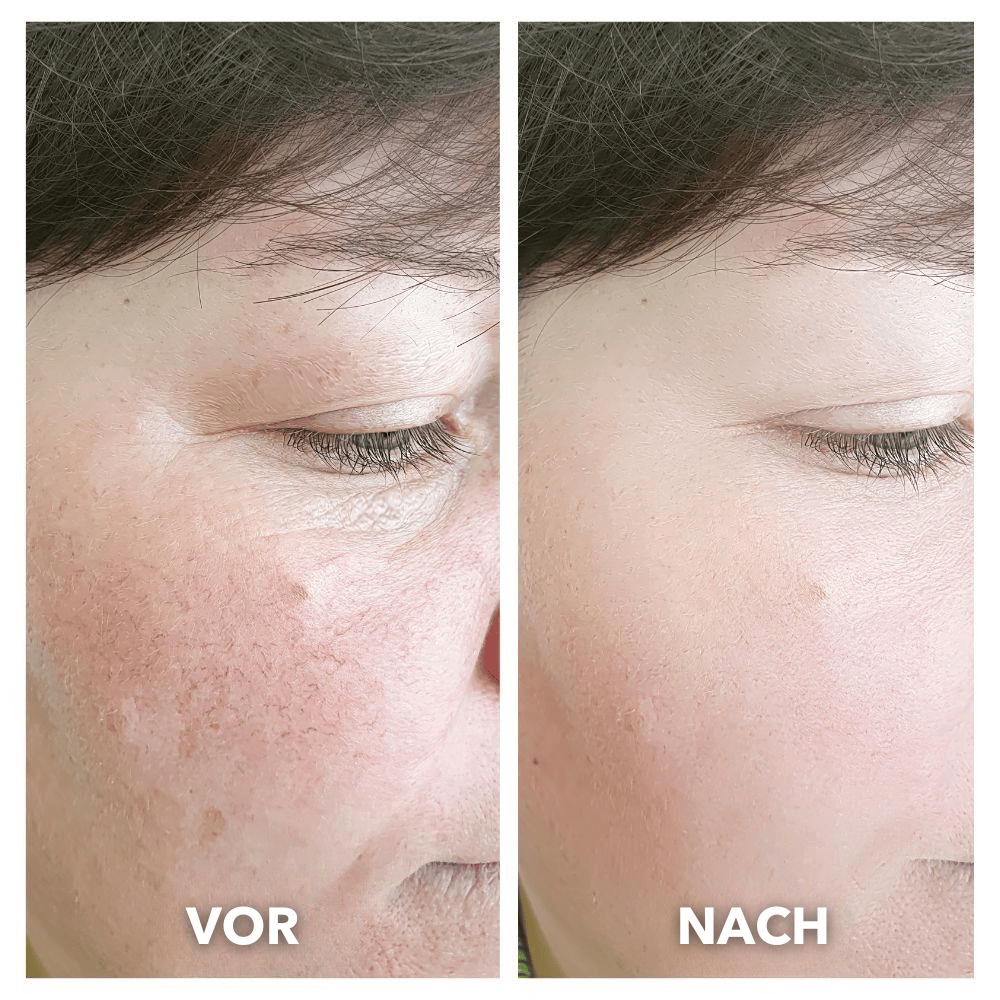 DERMALEA™ OPTO-RENEW Luxe