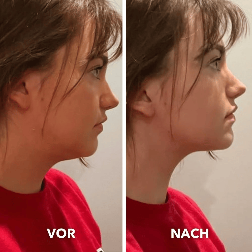 Intelligentes Gerät zur Gesichtsformung – 8 Modi zur Reduzierung des Doppelkinns und zur Definition der Kieferlinie