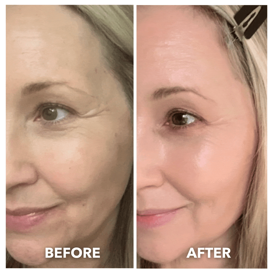 DERMALEA™ OPTO-RENEW Luxe